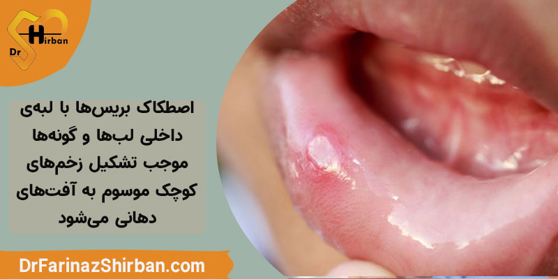 زخم شدن و افت زدن در ناحیه دهان