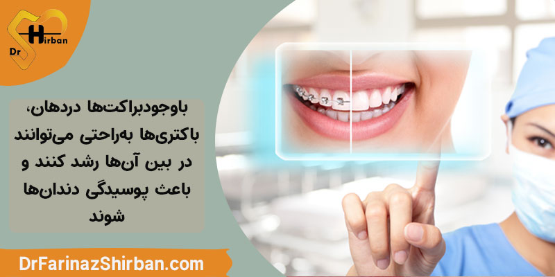 پوسیدگی دندان